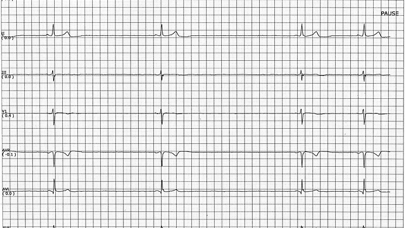 Minimizing Atrial Pacing No Benefit in Sinus Node Disease