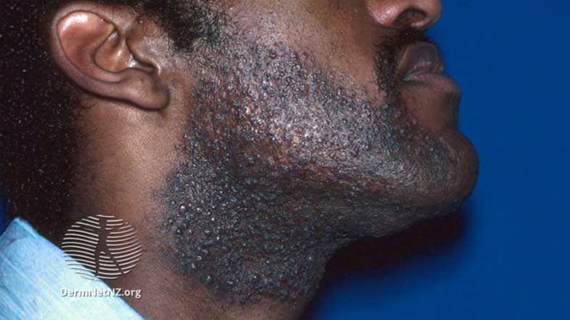 Pilot Study Educates Barbers About Pseudofolliculitis Barbae