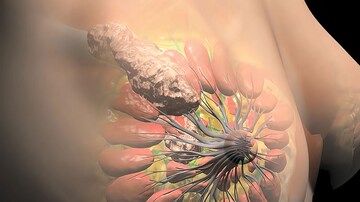 The Latest Findings on Major Breast Cancer Trials