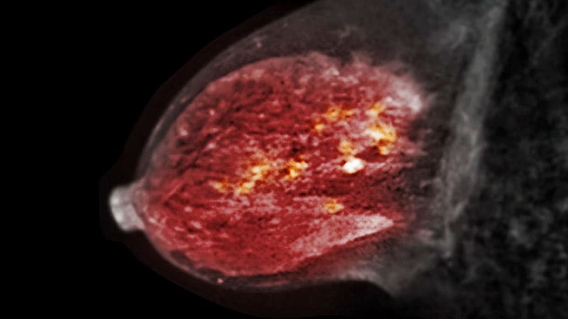 Compelling Case for Skipping RT in Some Early Breast Cancers