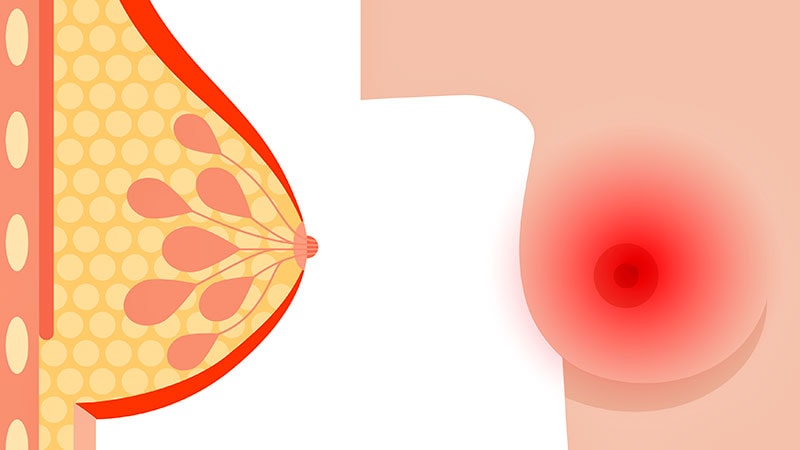 Few With Inflammatory Breast Cancer Get Guideline-Based Care