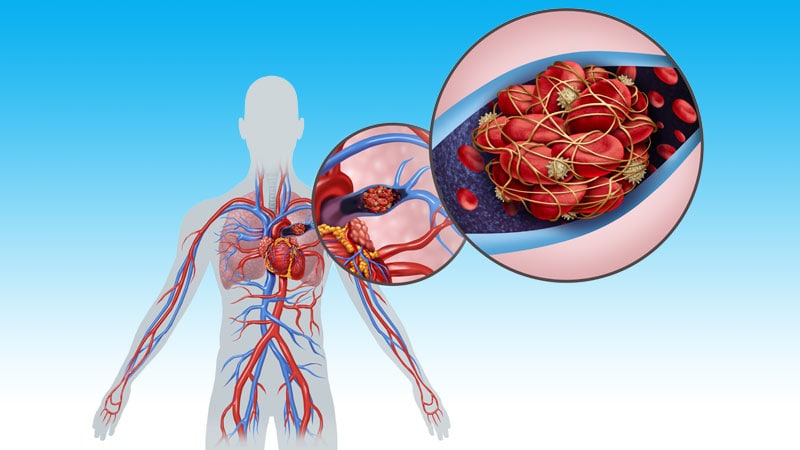 Catheter-Directed Plan Improves Pulmonary Artery Occlusion