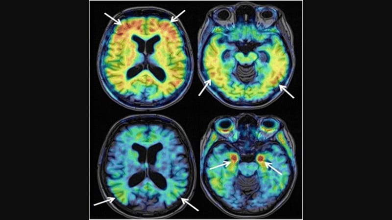 Promise For Alzheimers Disease With First Gene Silencing Drug