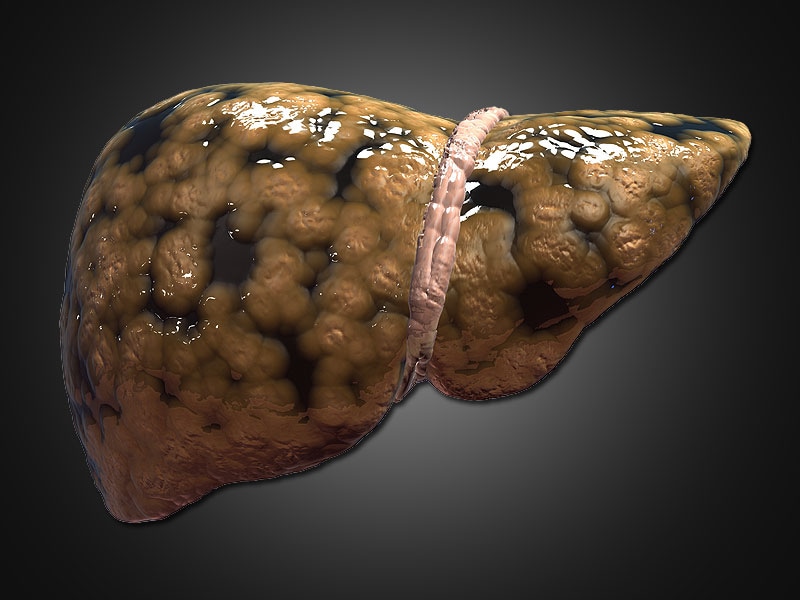 Ongoing Trials Put Focus Back on Fatty Liver Disease