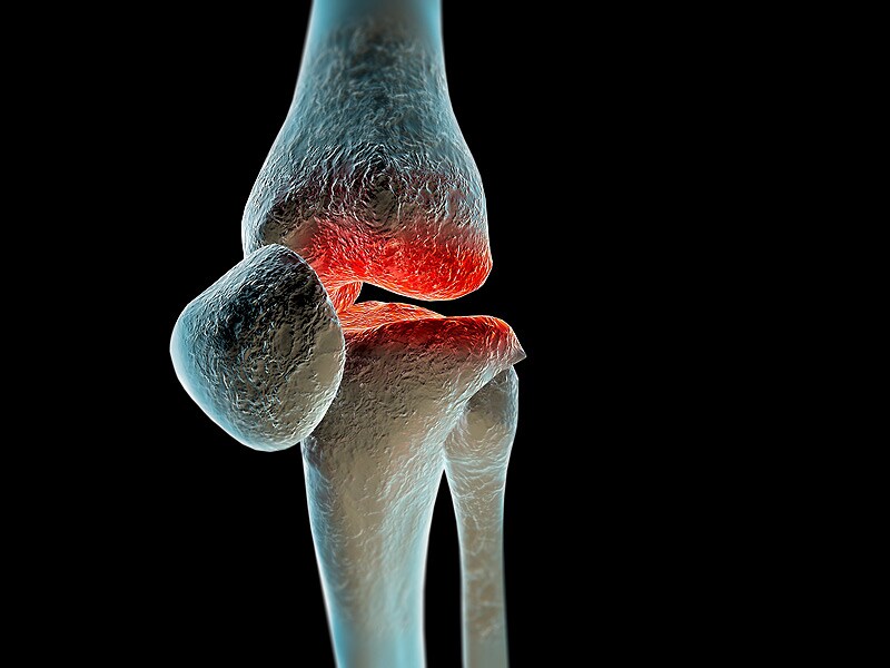 Nondrug Approaches to Osteoarthritis
