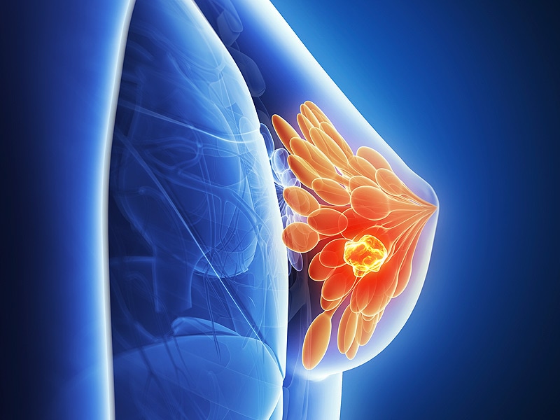  Can Anthracyclines Be Withheld in High-Risk HER2- Breast Cancer?