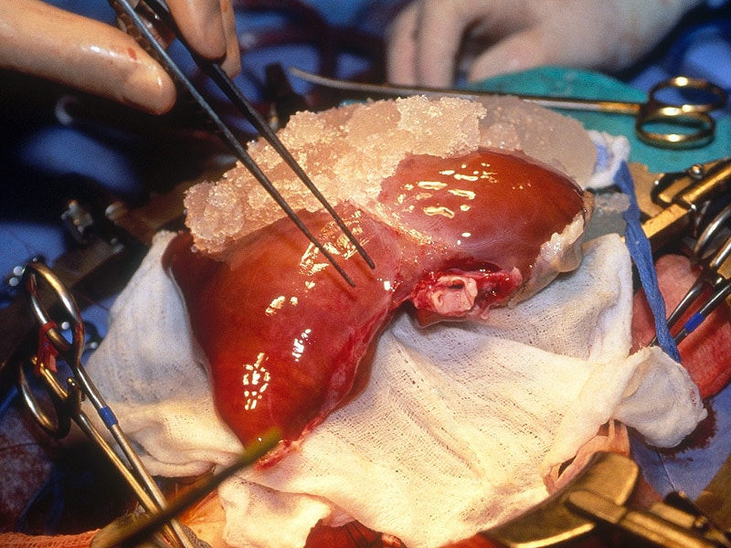 Innovations Are Brightening Liver Transplantation Outcomes