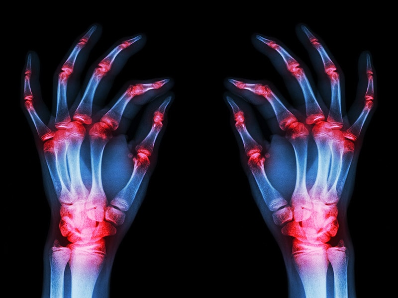 2015 Workforce Study and the Future for Rheumatologists