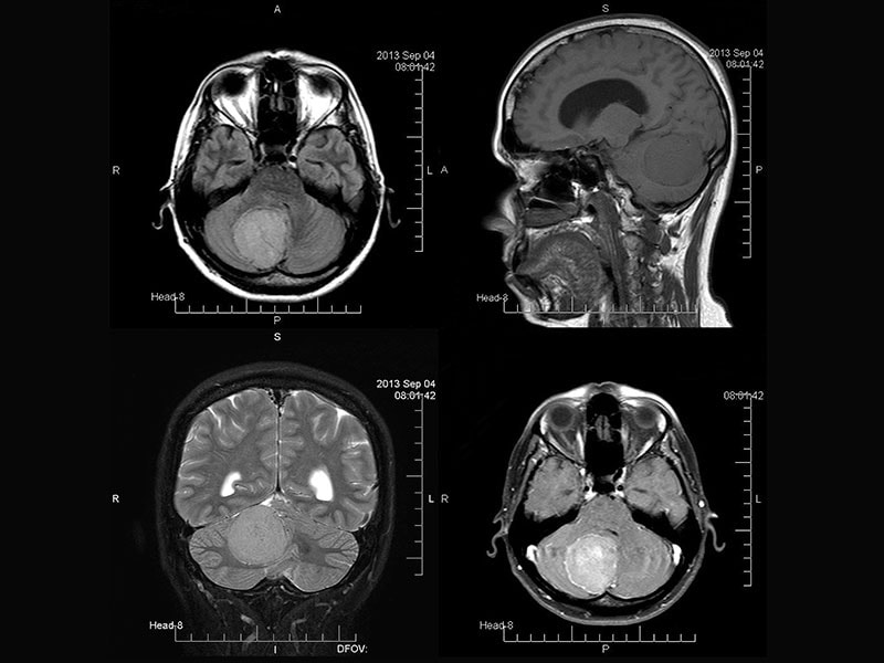 Where Does Whole Brain Radiation Fit in Lung Cancer Management?