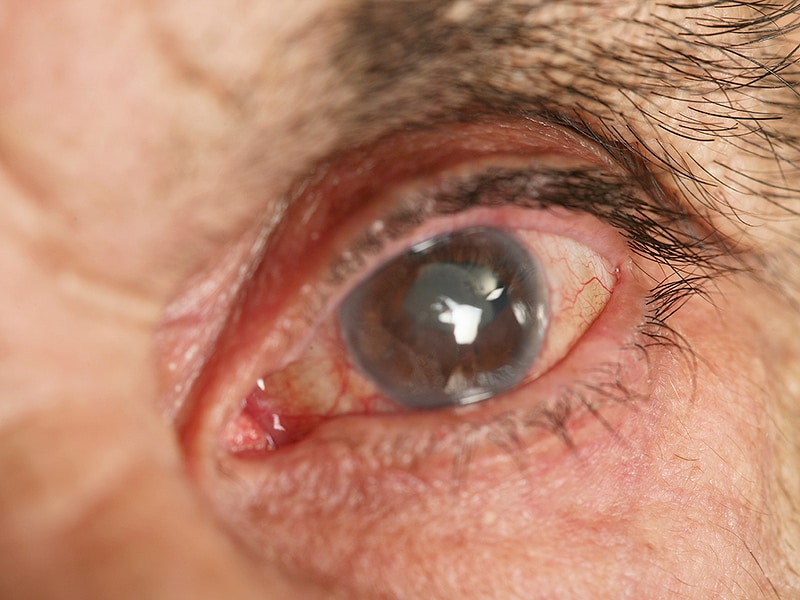 Advantages Claimed for Dropless Cataract Surgery