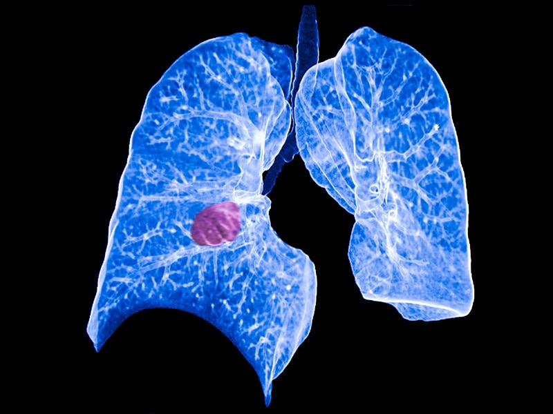 Adjuvant TKI Therapy for Early-Stage EGFR Mutation-Positive NSCLC