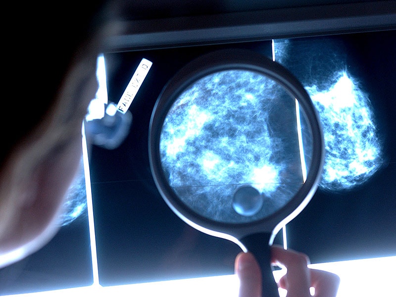 Neratinib Lowers Recurrence in High-Risk HER2+ Breast Cancer