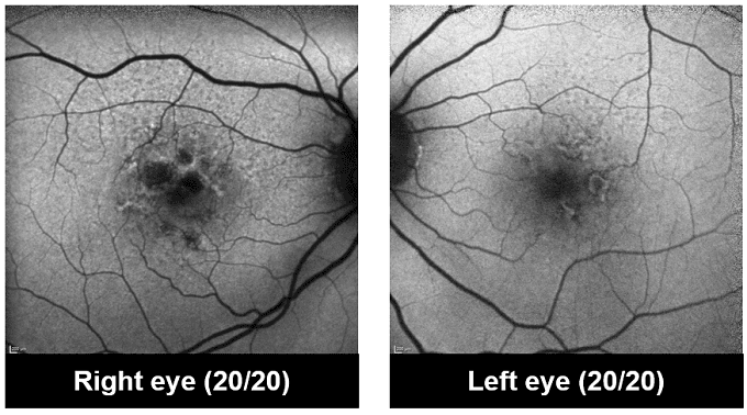 AMD and GA Cases: If and How to Treat