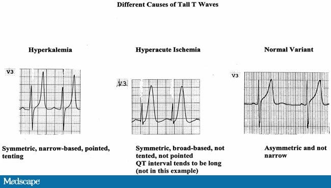 Series of Tall T Waves (I)