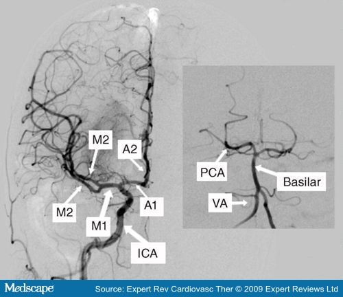 Neuroimaging of Ischemic Stroke With CT and MRI
