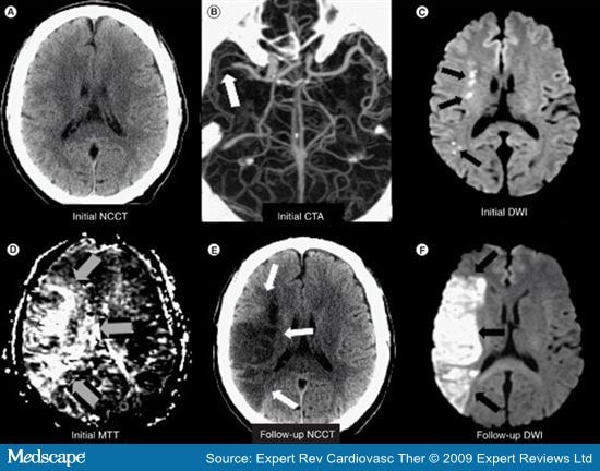 Neuroimaging of Ischemic Stroke With CT and MRI - Page 6