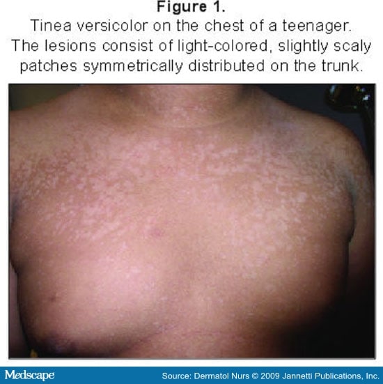 Skin Diseases Associated With the Malassezia Yeasts