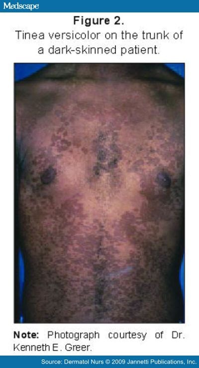 Skin Diseases Associated With the Malassezia Yeasts - Page 4