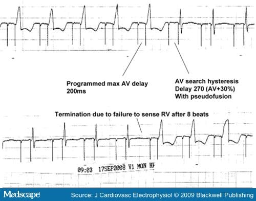 Pacing Features That Mimic Malfunction