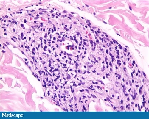 A 30-Year-Old Man With a 2-Year History of Rash