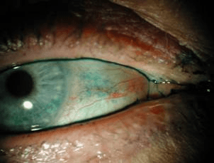 The View Ii Halting Progression Of Dry Eye Disease