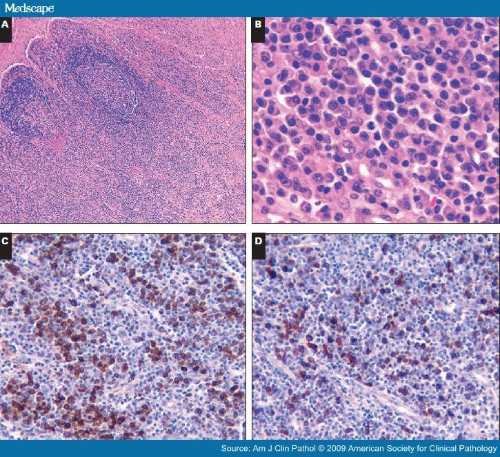 Complete Absence of KSHV/HHV-8 in Posttransplant Lymphoproliferative ...