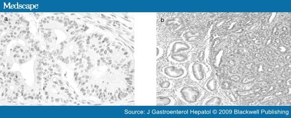 STAT3 Expression in Gastric Cancer Indicates a Poor Prognosis - Page 2