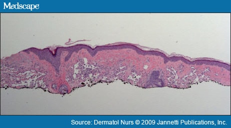 A Bruise-Like Patch to the Forehead and Scalp