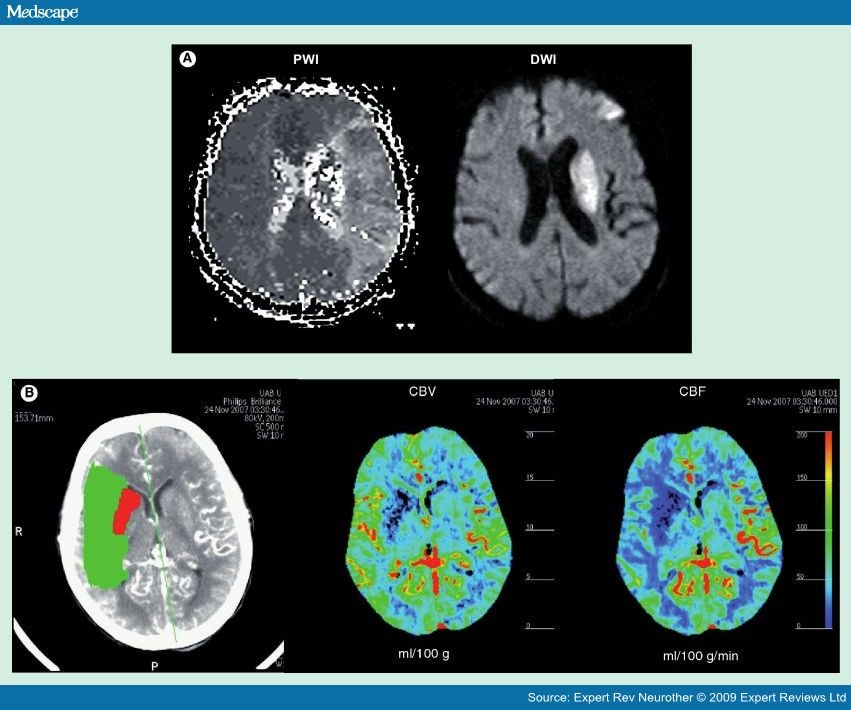 Use Of Neuroimaging In Acute Stroke Trials - Page 4