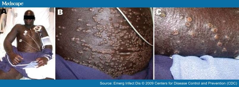 Eczema Herpeticum and Clinical Criteria for Investigating Smallpox