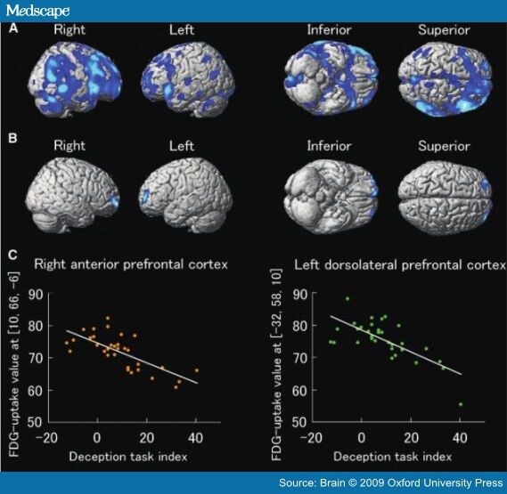 Do Parkinsonian Patients Have Trouble Telling Lies?