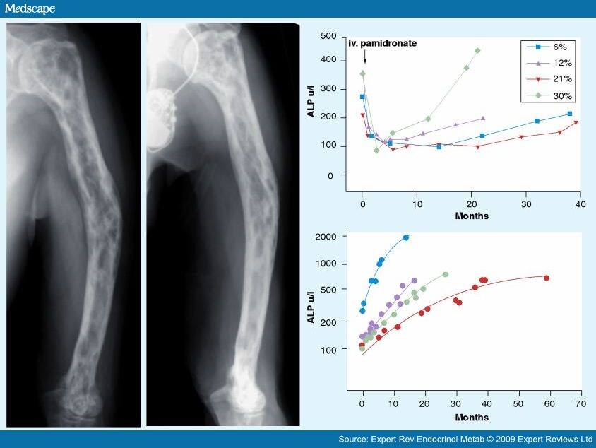 Paget's Disease of Bone