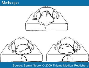 Benign Paroxysmal Positional Vertigo