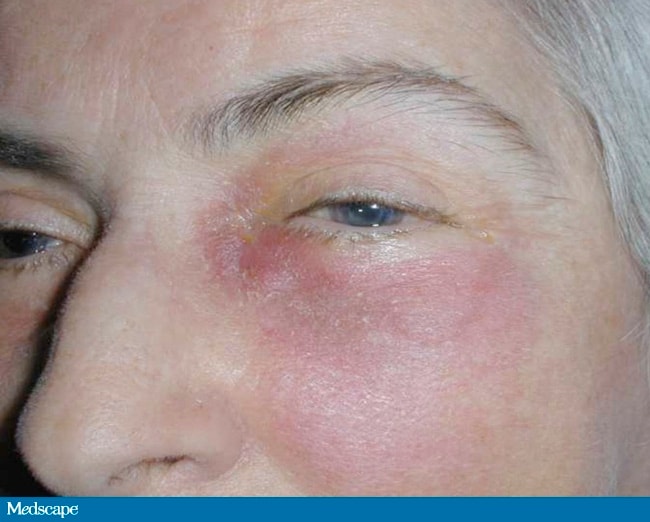 A 61-Year-Old Woman With Swelling of the Lower Eyelid