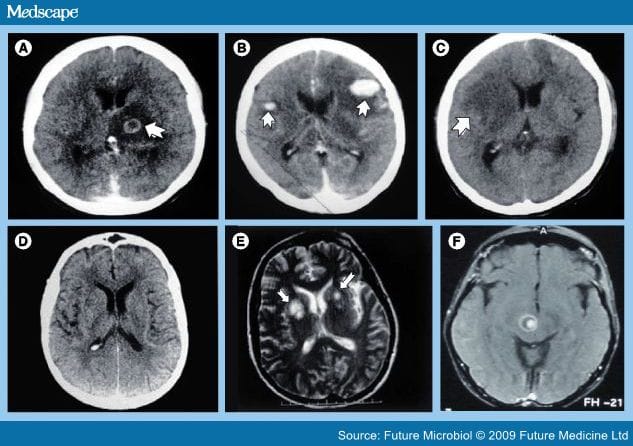 Toxoplasma Gondii and Cerebral Toxoplasmosis in HIV