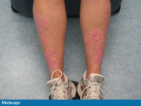 Mild psoriasis symptoms 