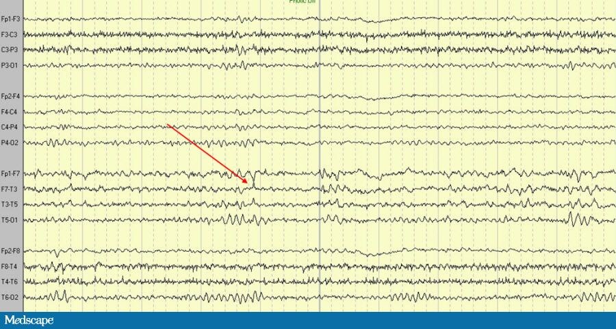 A 65-Year-Old Woman With Possible Seizures - Page 2