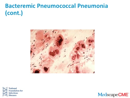 Invasive Pneumococcal Disease Burden -- What Can We Do About It? Town ...