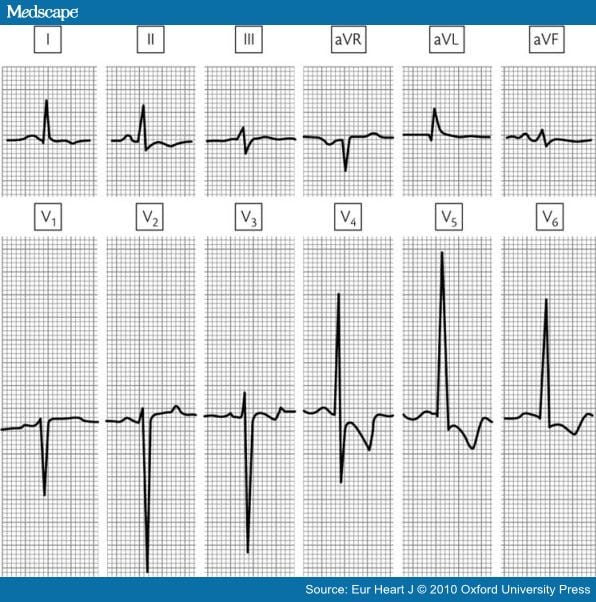 Recommendations for Interpretation of 12-Lead ECG in the Athlete