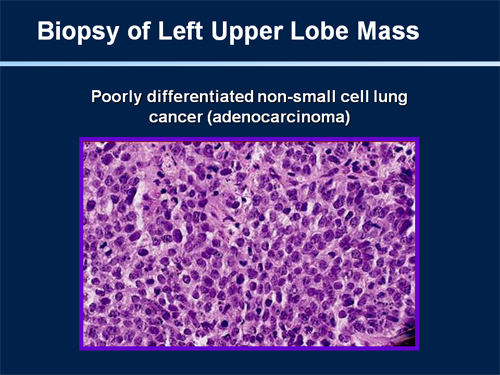 Case Presentation: Management of Locally Advanced Non-Small Cell Lung