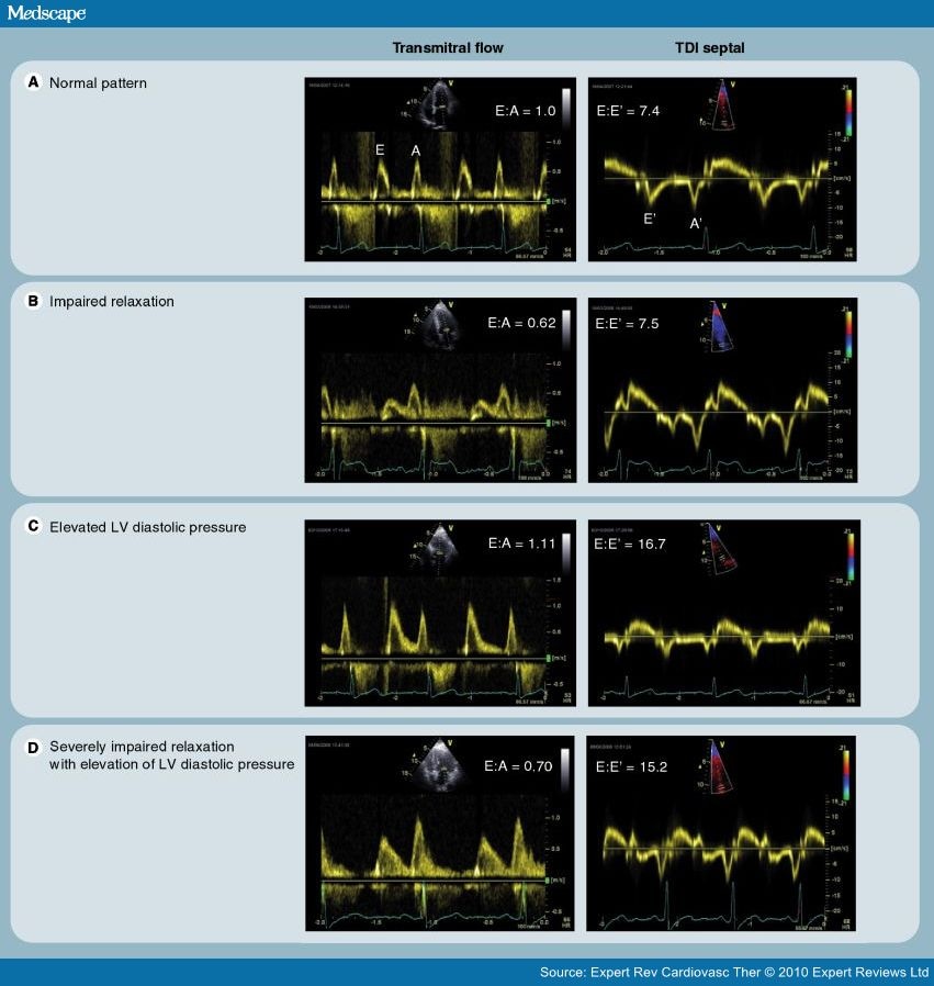 Systolic and Diastolic Left Ventricular Dysfunction