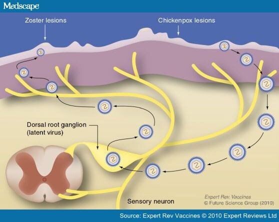 Herpes Zoster And Postherpetic Neuralgia Page 2