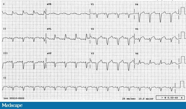 What Else Do You See Besides Left Bundle Branch Block I?