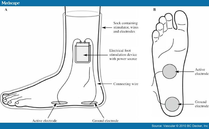 Electrical Foot Stimulation A Potential New Method of Deep Venous