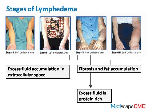 Lymphedema In Breast Cancer Survivors Update On Early Detection And Treatment Transcript 