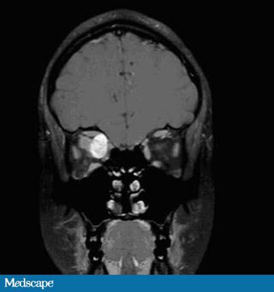 A 14 Year Old Girl With Sudden Onset Right Eye Pain And Proptosis Page 2 a-14-year-old-girl-with-sudden-onset-right-eye-pain-and-proptosis-page-2
