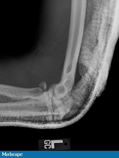 Case Report: Elbow Dislocation in Active Duty Marine