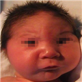 A Neonate With Dysmorphic Facial Features