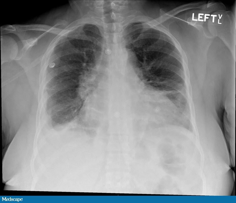 A 41-Year-Old Woman With Shortness of Breath, Hematuria, and ...