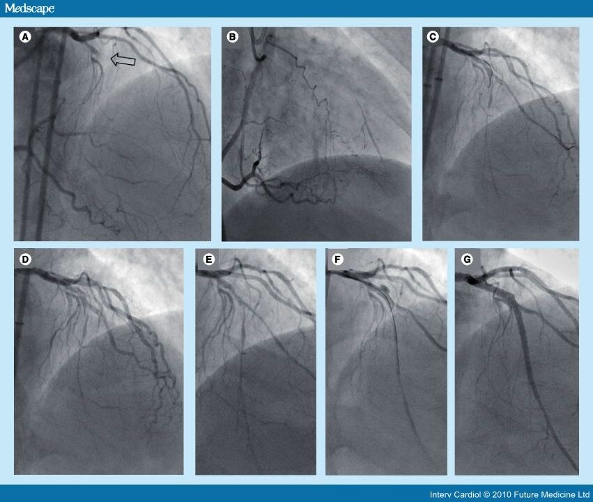 Cardiac and Extracardiac Complications During CTO Interventions - Page 5